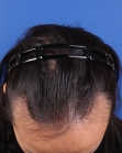 Before Hair Transplant&nbsp;Hairline